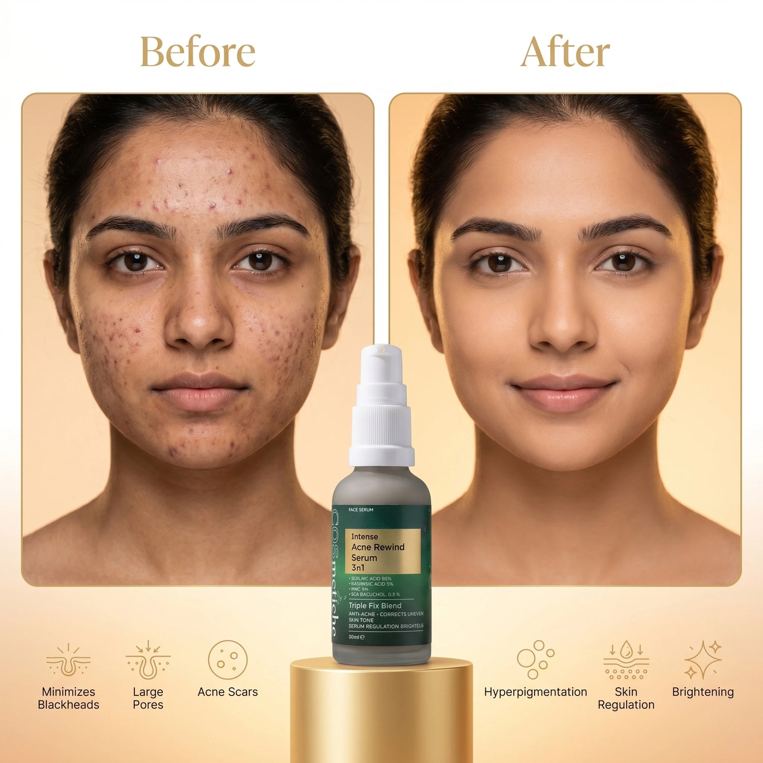 Intense Acne Rewind Serum
