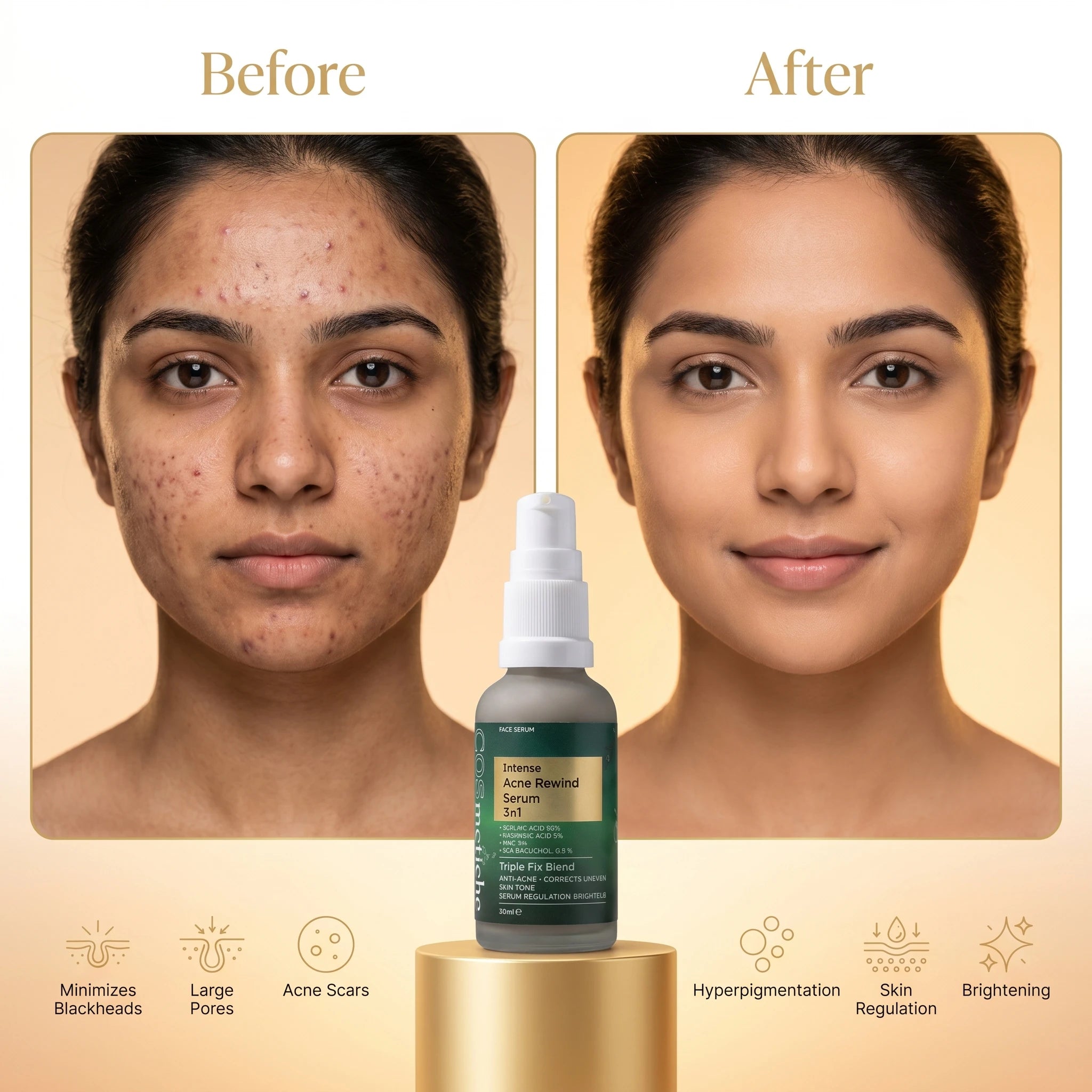 Intense Acne Rewind Serum