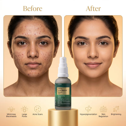 Intense Acne Rewind Serum